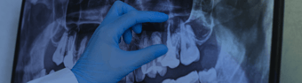 The Cost of Not Having Dental Insurance