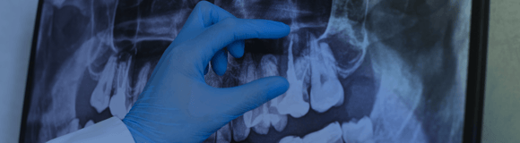 The Cost of Not Having Dental Insurance